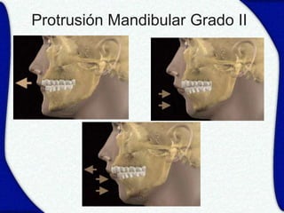 Protrusión Mandibular Grado II
 
