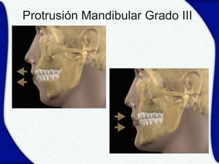 Protrusión Mandibular Grado III
 