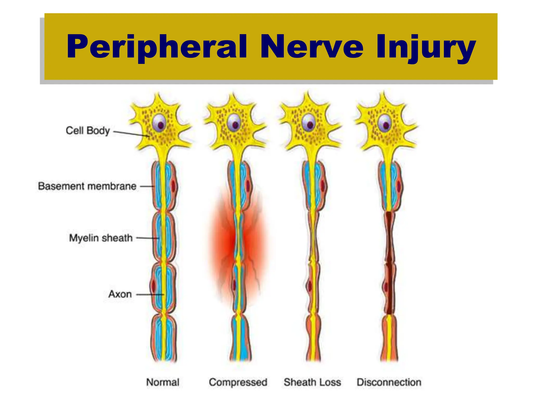 Peripheral Nerve Injury
 