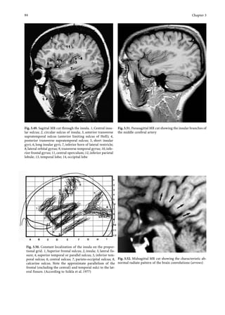 Cardunculus Brain Atlas of Regional ANATOMY of the Brain Using MRI | PDF