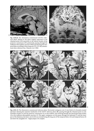 Atlas of Regional ANATOMY of the Brain Using MRI | PDF
