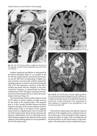 Marginal Ramus Atlas of Regional ANATOMY of the Brain Using MRI | PDF