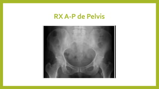 RX A-P de Pelvis
 