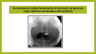 Se comienza a instilar lentamente el contraste, se aprecian
mejor defectos de llenado o del contorno
 