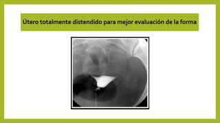 Útero totalmente distendido para mejor evaluación de la forma
 