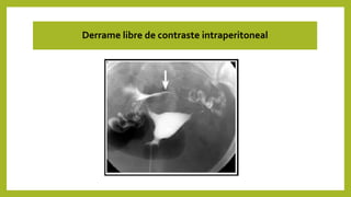 Derrame libre de contraste intraperitoneal
 