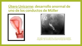 Útero Unicorne: desarrollo anormal de
uno de los conductos de Müller
Un solo cuerno uterino, con un contorno medial
irregular. Se visualiza una solaTrompa de Falopio
 