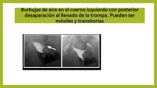 Burbujas de aire en el cuerno izquierdo con posterior
desaparación al llenado de la trompa. Pueden ser
móviles y transitorias
 