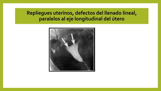 Repliegues uterinos, defectos del llenado lineal,
paralelos al eje longitudinal del útero
 