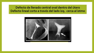 Defecto de llenado central oval dentro del útero
Defecto lineal corto a través del lado izq. cerca al istmo
 