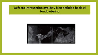 Defecto intrauterino ovoide y bien definido hacia el
fondo uterino
 