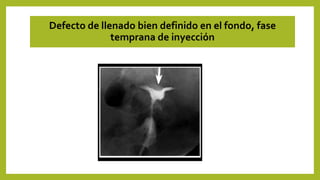 Defecto de llenado bien definido en el fondo, fase
temprana de inyección
 