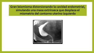 Gran leiomioma distorsionando la cavidad endometrial,
simulando una masa extrínseca que desplaza el
miometrio del contorno uterino izquierdo
 