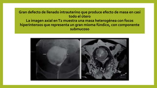 Gran defecto de llenado intrauterino que produce efecto de masa en casi
todo el útero
La imagen axial enT2 muestra una masa heterogénea con focos
hiperintensos que representa un gran mioma fúndico, con componente
submucoso
 