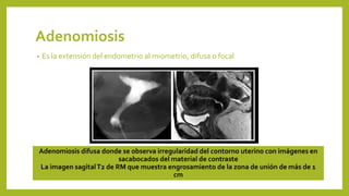 Adenomiosis
• Es la extensión del endometrio al miometrio, difusa o focal
Adenomiosis difusa donde se observa irregularidad del contorno uterino con imágenes en
sacabocados del material de contraste
La imagen sagitalT2 de RM que muestra engrosamiento de la zona de unión de más de 1
cm
 
