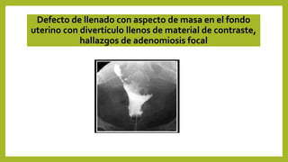 Defecto de llenado con aspecto de masa en el fondo
uterino con divertículo llenos de material de contraste,
hallazgos de adenomiosis focal
 