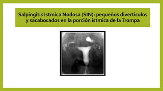 Salpingitis Istmica Nodosa (SIN): pequeños divertículos
y sacabocados en la porción ístmica de laTrompa
 