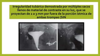 Irregularidad tubárica demostrada por múltiples sacos
llenos de material de contraste en su luz, que se
proyectan de 2 a 3 mm por fuera de la porción ístmica de
ambas trompas (SIN
 