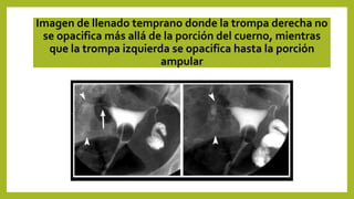 Imagen de llenado temprano donde la trompa derecha no
se opacifica más allá de la porción del cuerno, mientras
que la trompa izquierda se opacifica hasta la porción
ampular
 