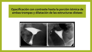 Opacificación con contraste hasta la porción ístmica de
ambas trompas y dilatación de las estructuras distaes
 