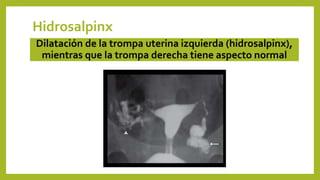 Dilatación de la trompa uterina izquierda (hidrosalpinx),
mientras que la trompa derecha tiene aspecto normal
Hidrosalpinx
 