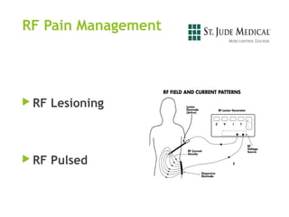  RF Lesioning
 RF Pulsed
RF Pain Management
 