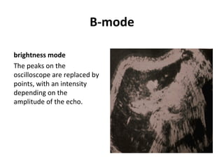 B-mode
brightness mode
The peaks on the
oscilloscope are replaced by
points, with an intensity
depending on the
amplitude of the echo.
 