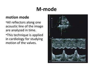 M-mode
motion mode
•All reflectors along one
acoustic line of the image
are analyzed in time.
•This technique is applied
in cardiology for studying
motion of the valves.
 
