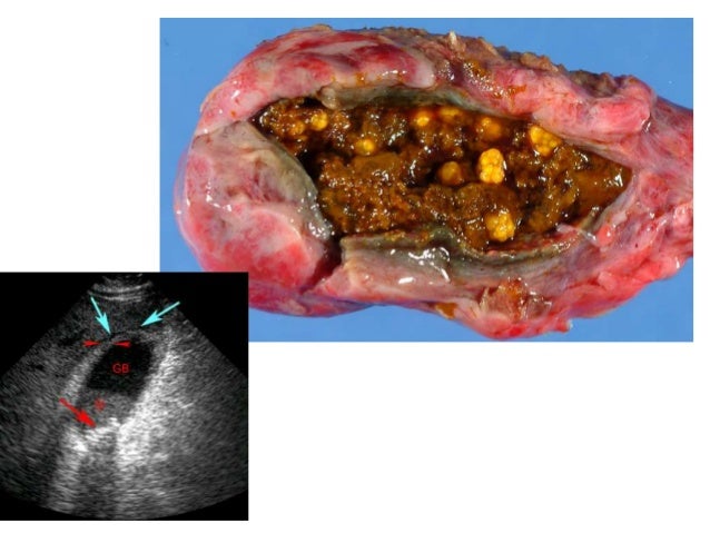 Gallbladder Disease in Children