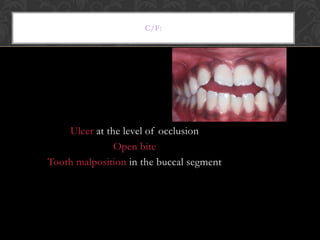 C/F:
Ulcer at the level of occlusion
Open bite
Tooth malposition in the buccal segment
 