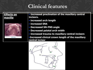 Effects on
maxilla
• Increased proclination of the maxillary central
incisors.
• increased arch length
• increased SNA
• Decreased SN-PNS angle
• Decreased palatal arch width
• Increased trauma to maxillary central incisors
•Increased clinical crown length of the maxillary
central incisor
Clinical features
 