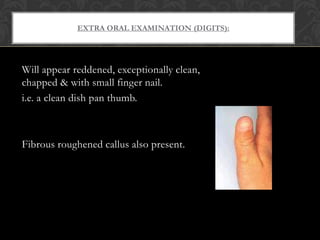 EXTRA ORAL EXAMINATION (DIGITS):
Will appear reddened, exceptionally clean,
chapped & with small finger nail.
i.e. a clean dish pan thumb.
Fibrous roughened callus also present.
 