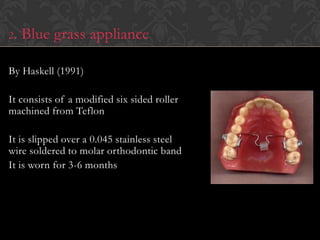 2. Blue grass appliance
By Haskell (1991)
It consists of a modified six sided roller
machined from Teflon
It is slipped over a 0.045 stainless steel
wire soldered to molar orthodontic band
It is worn for 3-6 months
 