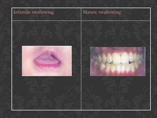 Infantile swallowing Mature swallowing
 