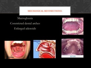 MECHANICAL RESTRICTIONS:
Macroglossia
Constricted dental arches
Enlarged adenoids
 