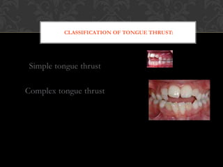 CLASSIFICATION OF TONGUE THRUST:
Simple tongue thrust
Complex tongue thrust
 