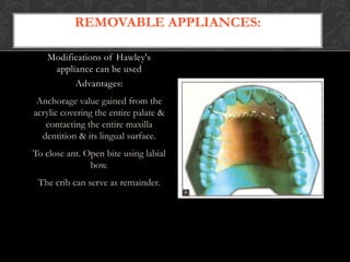 REMOVABLE APPLIANCES:
Modifications of Hawley's
appliance can be used
Advantages:
Anchorage value gained from the
acrylic covering the entire palate &
contacting the entire maxilla
dentition & its lingual surface.
To close ant. Open bite using labial
bow.
The crib can serve as remainder.
 