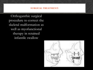 SURGICAL TREATMENT:
Orthoganthic surgical
procedure to correct the
skeletal malformation as
well as myofunctional
therapy in retained
infantile swallow
 