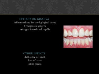 EFFECTS ON GINGIVA
inflammed and irritated gingival tissue
hyperplastic gingiva
enlarged interdental papilla
OTHER EFFECTS
dull sense of smell
loss of taste
otitis media
 