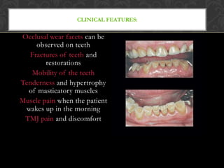 CLINICAL FEATURES:
Occlusal wear facets can be
observed on teeth
Fractures of teeth and
restorations
Mobility of the teeth
Tenderness and hypertrophy
of masticatory muscles
Muscle pain when the patient
wakes up in the morning
TMJ pain and discomfort
 