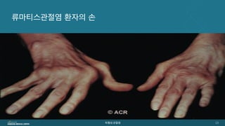 [삼성서울병원] 퇴행성관절염 