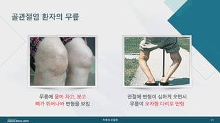[삼성서울병원] 퇴행성관절염 