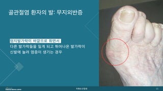 [삼성서울병원] 퇴행성관절염 