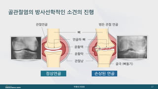 [삼성서울병원] 퇴행성관절염 