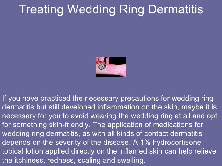 the truth about wedding rings and wedding ring dermatitis 9 728