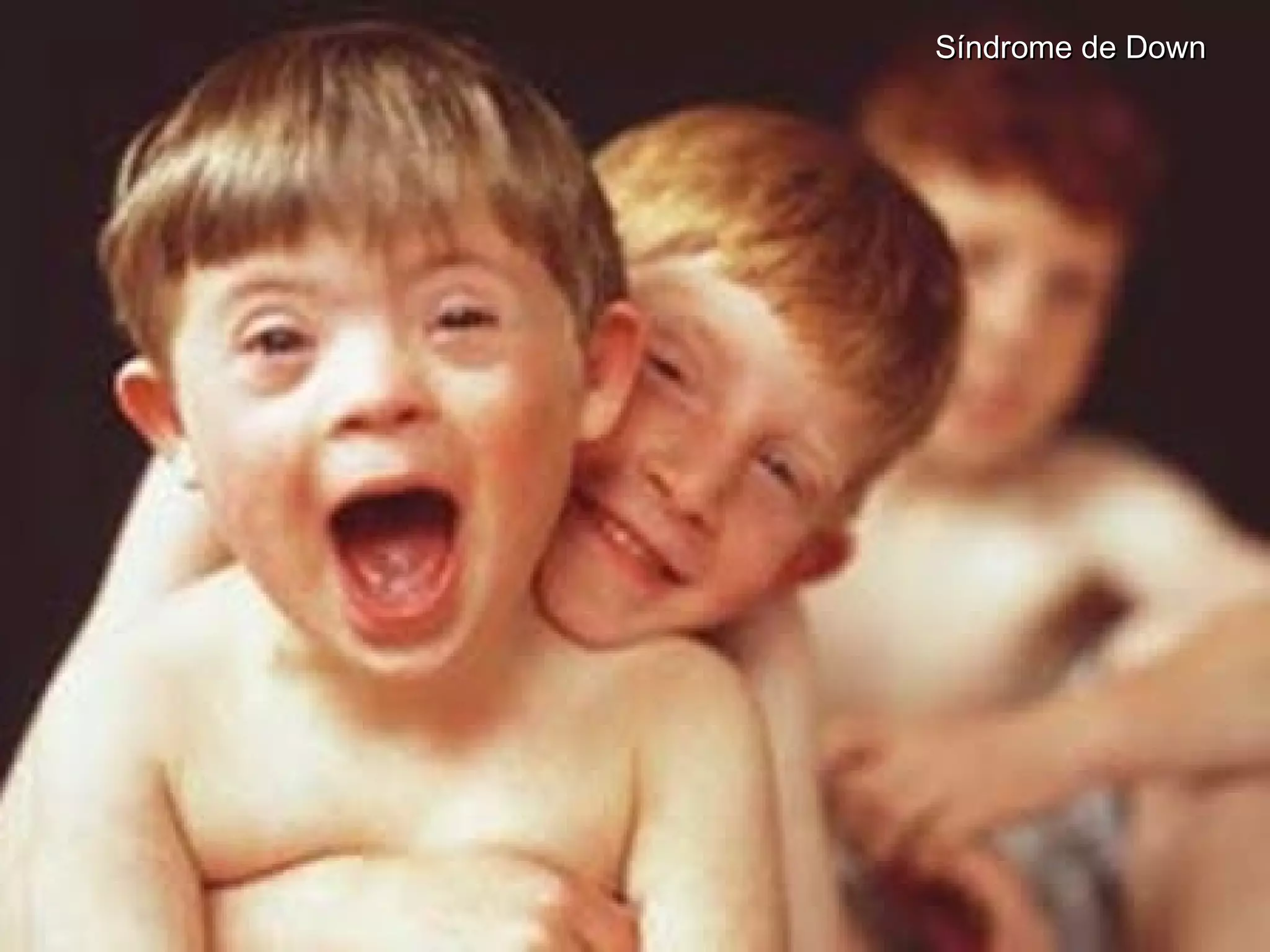 Síndrome de DownSíndrome de Down
 