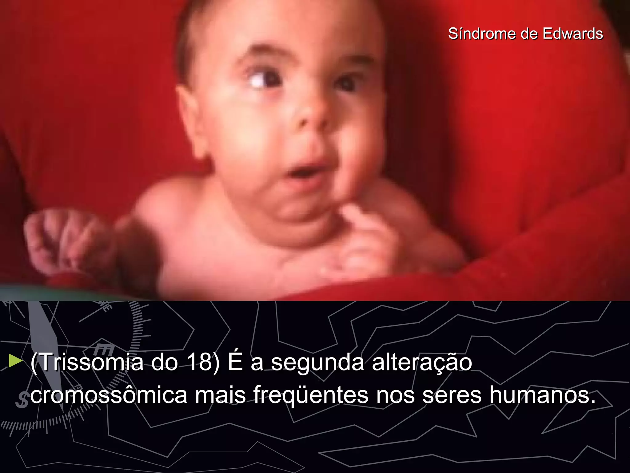 ► (Trissomia do 18) É a segunda alteração(Trissomia do 18) É a segunda alteração
cromossômica mais freqüentes nos seres humanos.cromossômica mais freqüentes nos seres humanos.
Síndrome de EdwardsSíndrome de Edwards
 