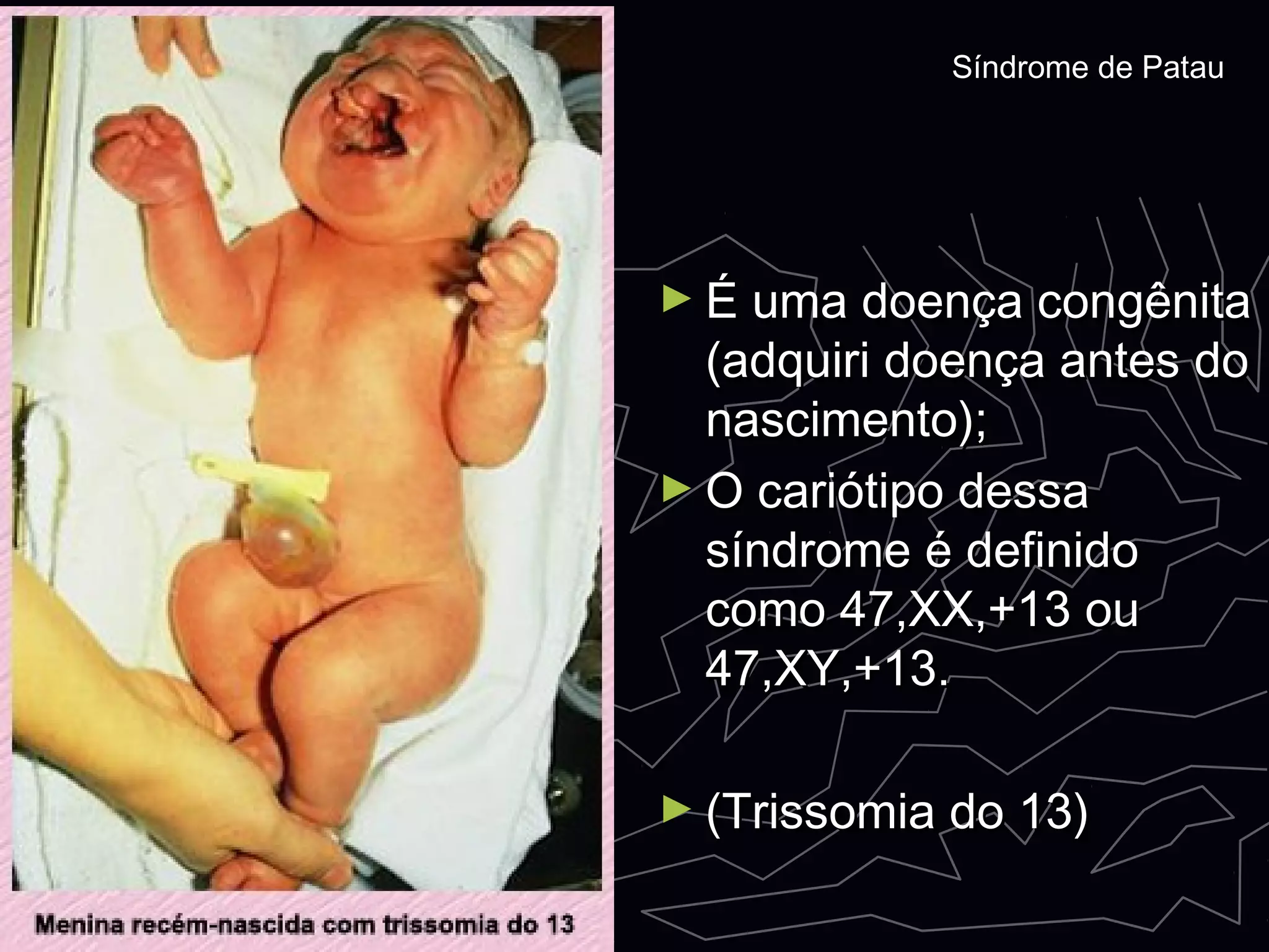 ► É uma doença congênitaÉ uma doença congênita
(adquiri doença antes do(adquiri doença antes do
nascimento);nascimento);
► O cariótipo dessaO cariótipo dessa
síndrome é definidosíndrome é definido
como 47,XX,+13 oucomo 47,XX,+13 ou
47,XY,+13.47,XY,+13.
► (Trissomia do 13)(Trissomia do 13)
Síndrome de PatauSíndrome de Patau
 