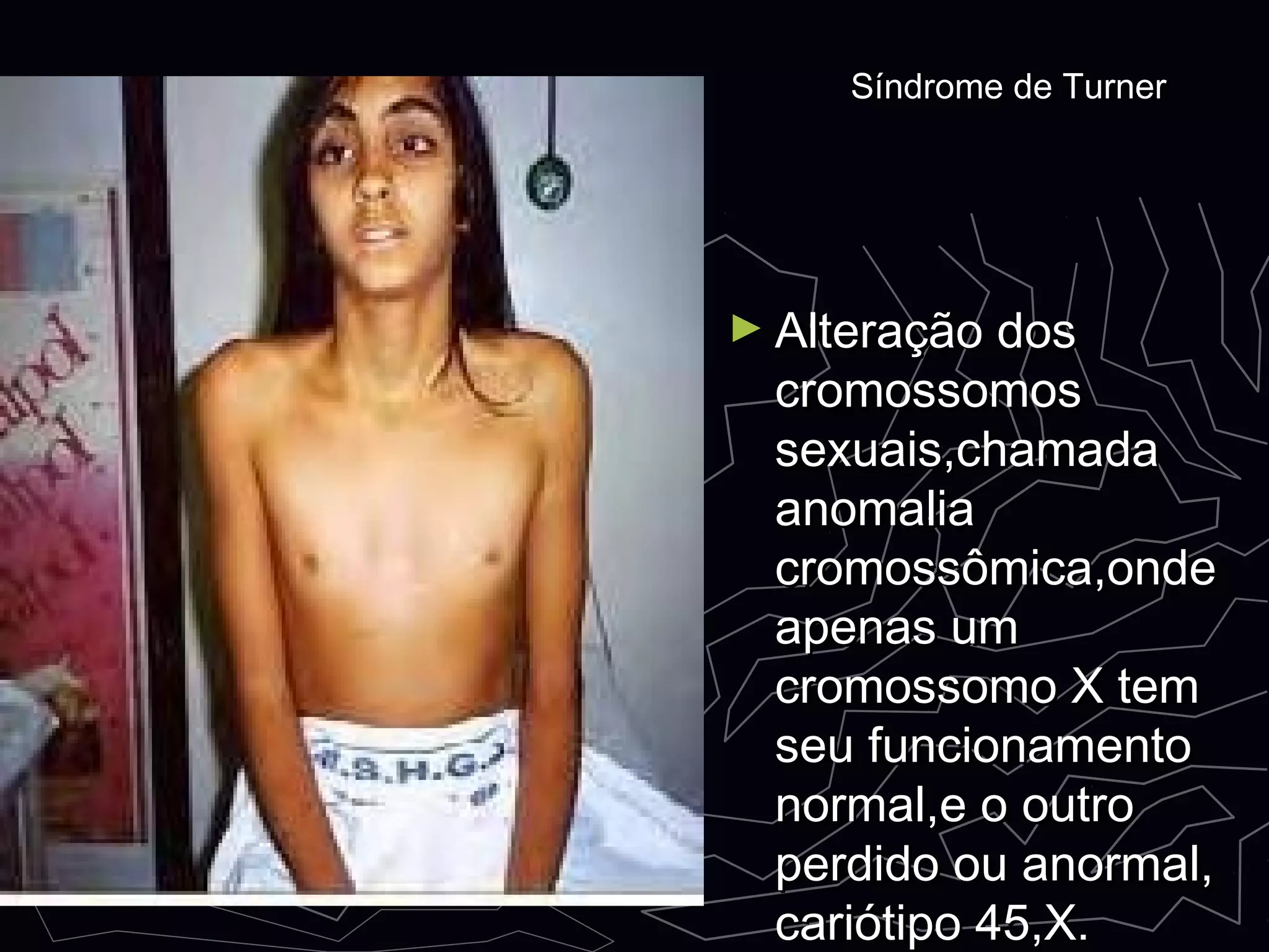► Alteração dosAlteração dos
cromossomoscromossomos
sexuais,chamadasexuais,chamada
anomaliaanomalia
cromossômica,ondecromossômica,onde
apenas umapenas um
cromossomo X temcromossomo X tem
seu funcionamentoseu funcionamento
normal,e o outronormal,e o outro
perdido ou anormal,perdido ou anormal,
cariótipo 45,X.cariótipo 45,X.
Síndrome de TurnerSíndrome de Turner
 