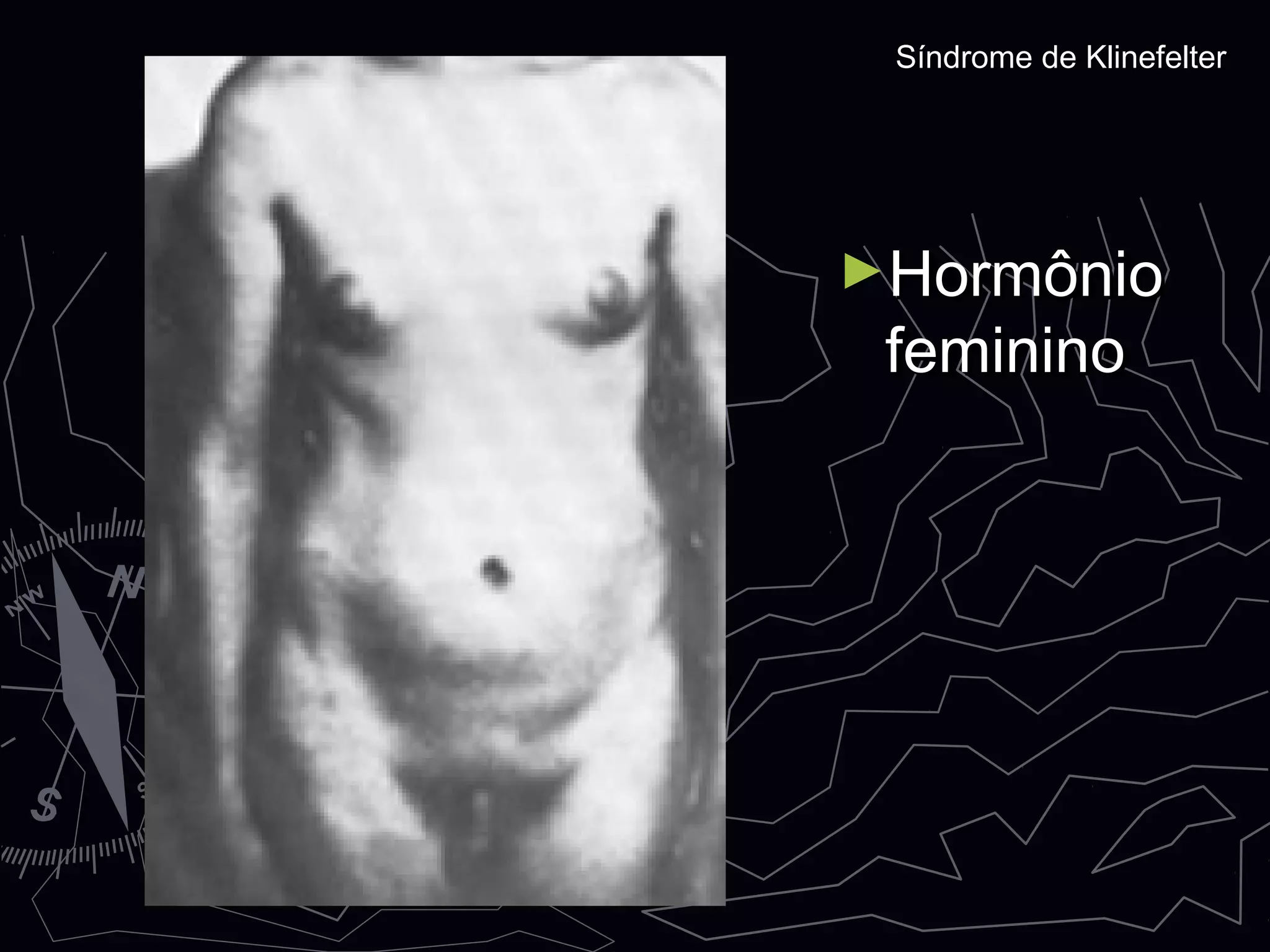 ►HormônioHormônio
femininofeminino
Síndrome de KlinefelterSíndrome de Klinefelter
 